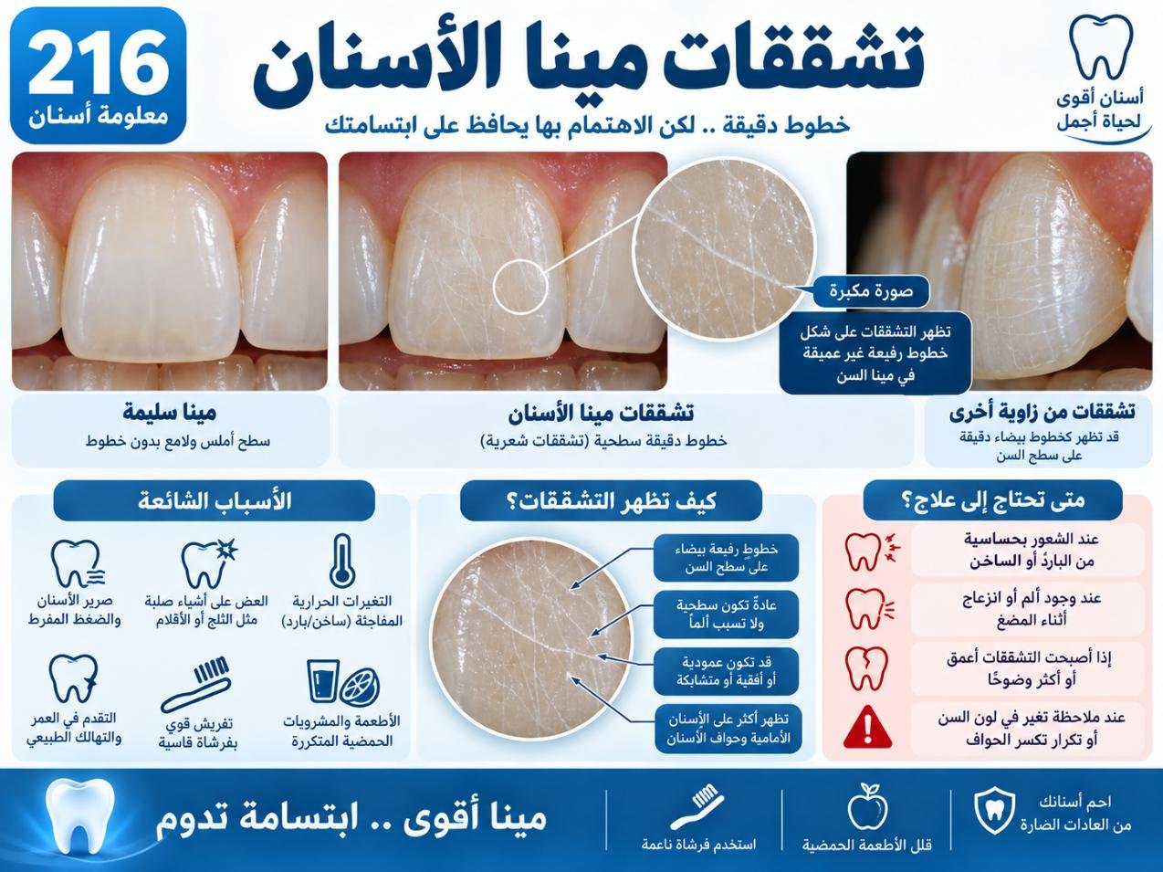 تشققات مينا الأسنان: الأسباب والتشخيص وخيارات العلاج