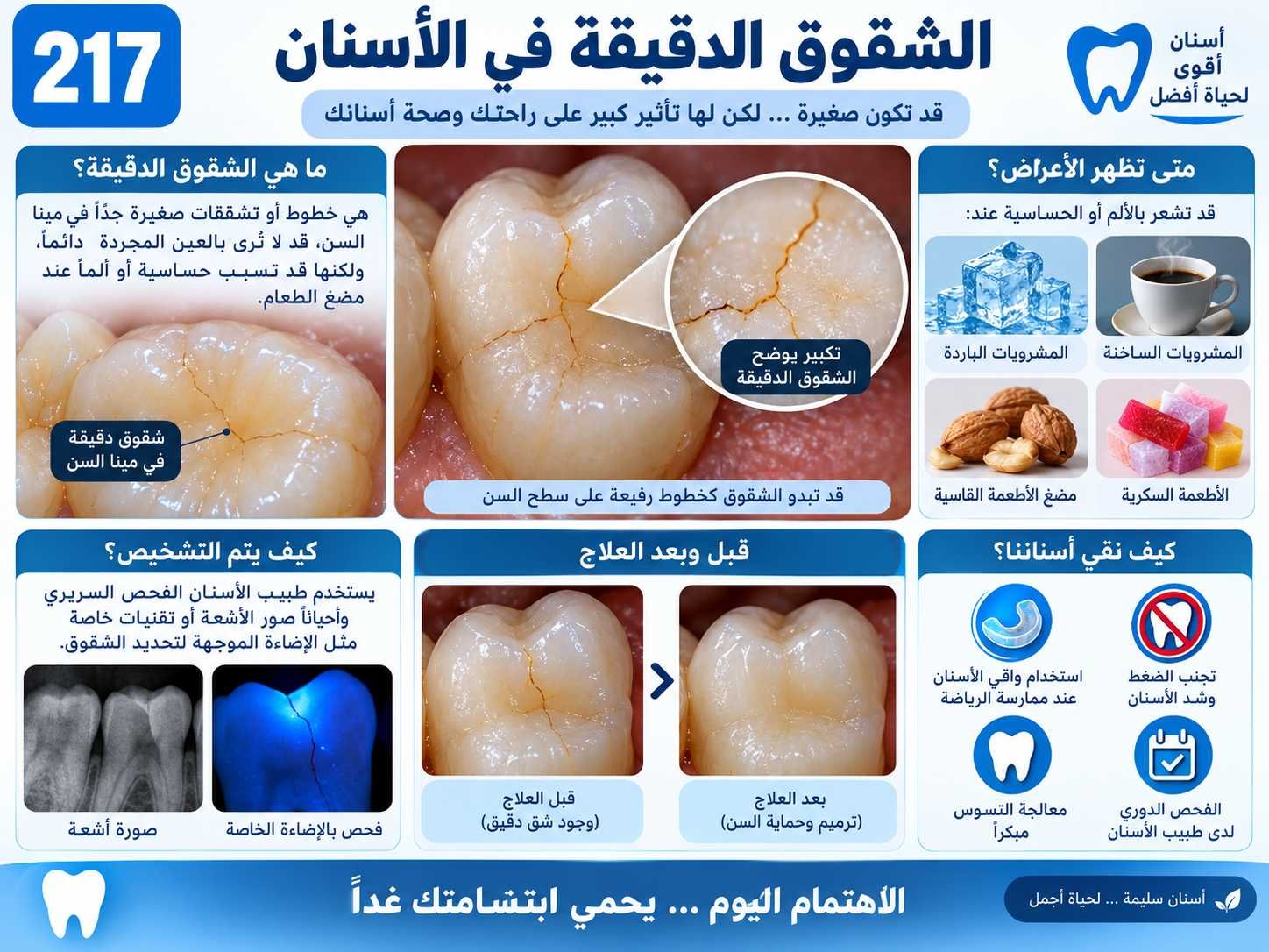 الشقوق الدقيقة في الأسنان: الأسباب والتشخيص وخيارات العلاج