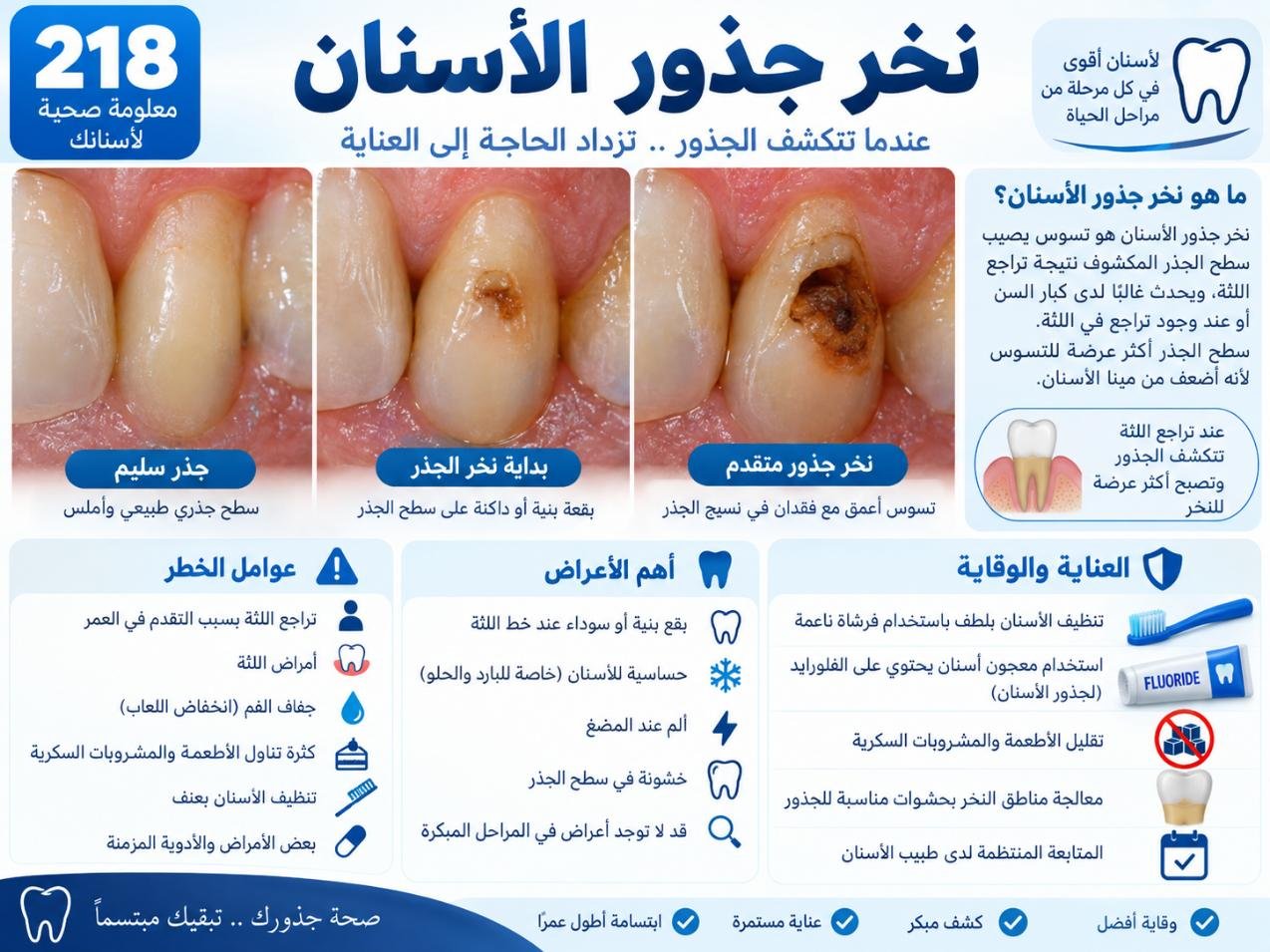 نخر جذور الأسنان: الأسباب والتشخيص وخيارات العلاج