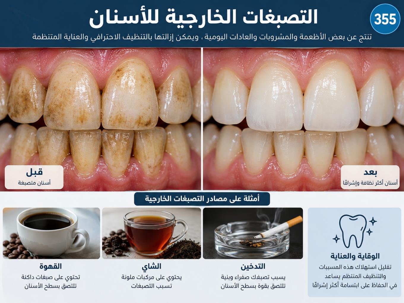 التصبغات الخارجية للأسنان: الأسباب والتشخيص وخيارات العلاج